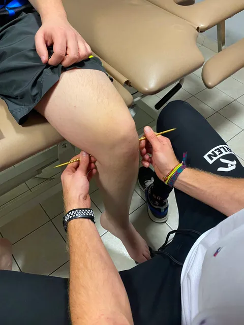 Dry needling applied to knee trigger points