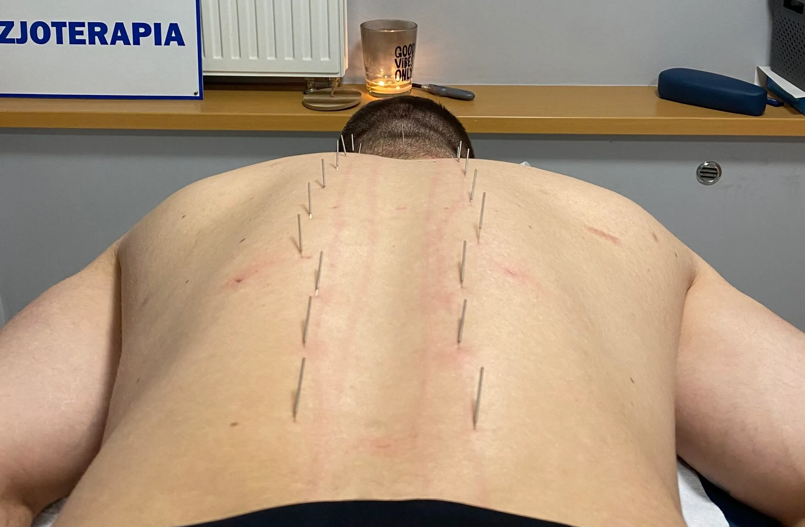Acupuncture needles aligned along a patient's spine at GraMedica clinic